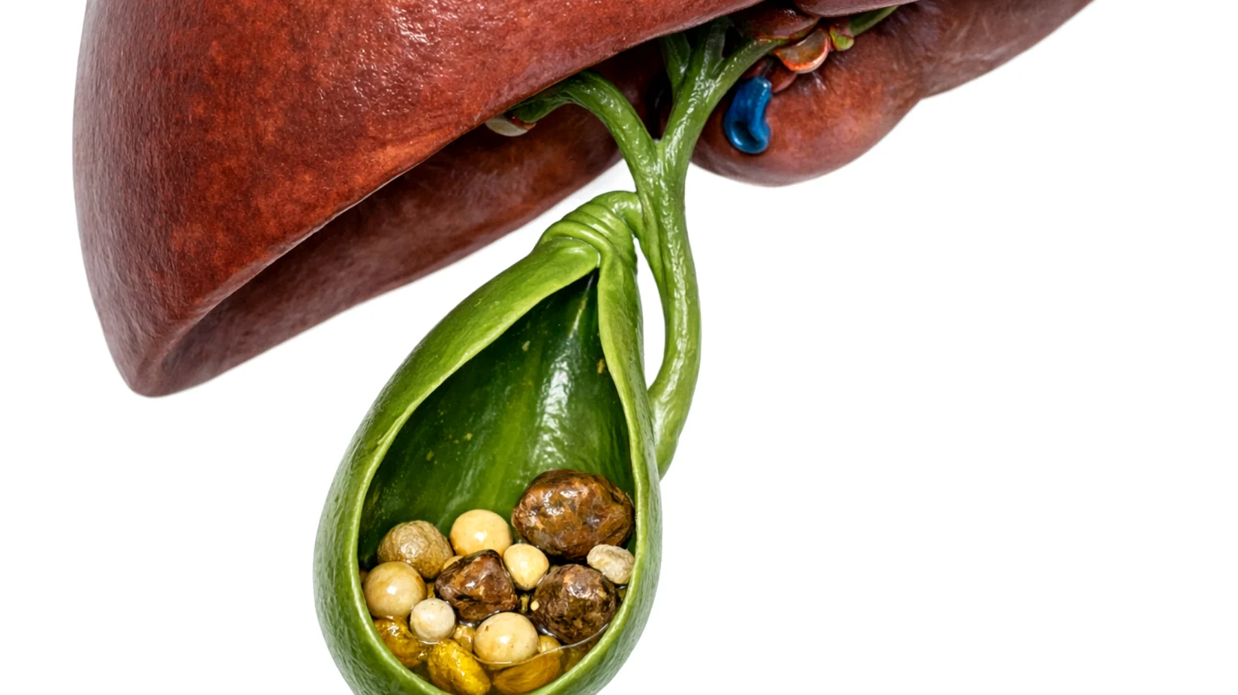 I calcoli biliari sono una condizione molto comune, ma spesso sottovalutata. In molti casi si formano silenziosamente, senza dare sintomi evidenti, rendendo difficile una diagnosi precoce. Tuttavia, quando iniziano a causare disturbi, i dolori possono essere intensi e invalidanti. Conoscere le cause più comuni della loro formazione — come un'alimentazione ricca di grassi saturi, la sedentarietà , la predisposizione genetica, il sovrappeso o rapide perdite di peso — è fondamentale per prevenirli e agire in tempo prima che si renda necessario un intervento chirurgico."